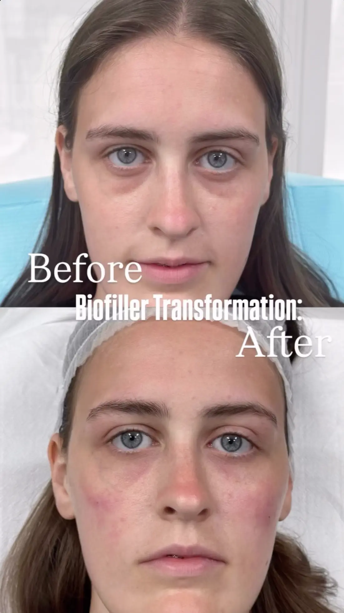 EZ Gel Under Eyes Before and After - Tear Trough Correction PRF Biofiller London before and after – under-eye EZ Gel (Alb-PRF)
