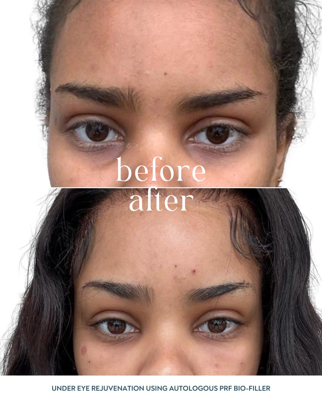 EZ Gel Before and After - Dark Circles and Hollow Correction PRF Biofiller London before and after – combination PRP and EZ Gel for dark circles and hollows