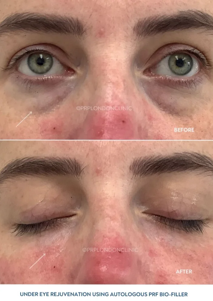EZ Gel Filler Before and After - Mid-Face Volume Restoration PRF Biofiller London before and after – mid-face volumisation