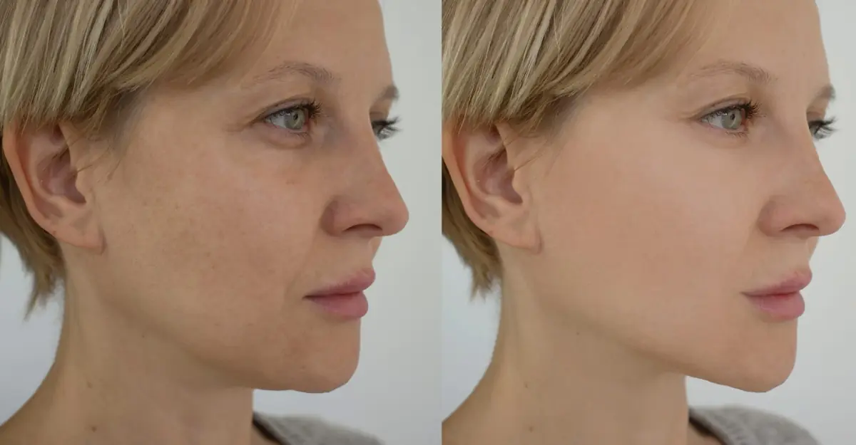 Before and after cheek fillers treatment results
