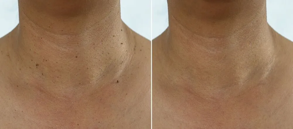 Close-up image of a common skin tag on the skin.