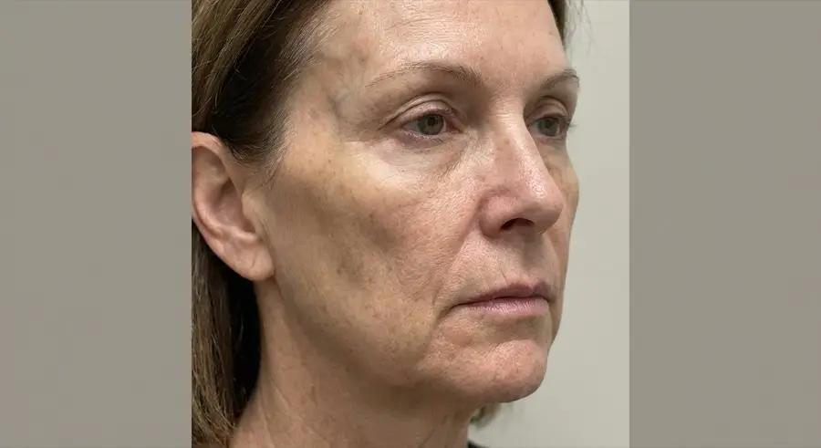 Illustration of typical signs of facial volume loss including temple hollowing, flattened cheeks, and deepened nasolabial folds