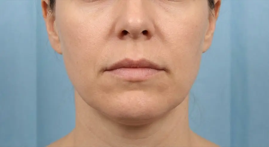 Illustration of early jowling showing mild softening of jawline definition