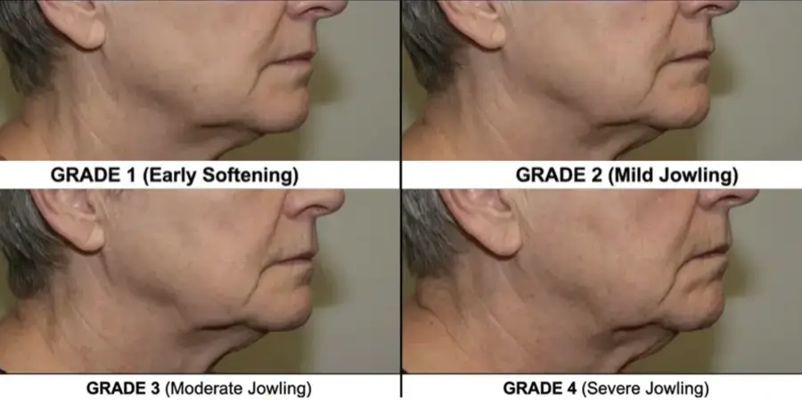Illustration comparing Grade 1 mild through Grade 4 severe jowling along the jawline