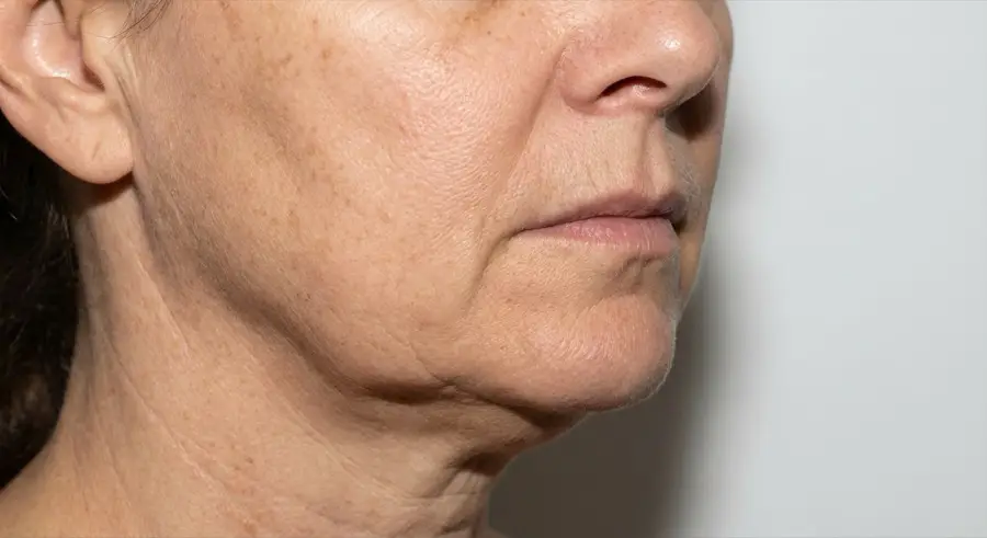 Illustration showing visible jowls with tissue hanging below the jawline and loss of definition