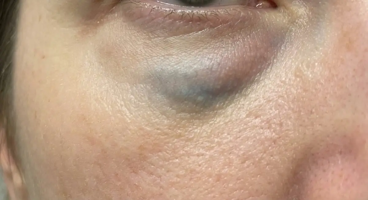 Example of Tyndall effect showing blue-grey discolouration under the eye caused by superficial filler placement