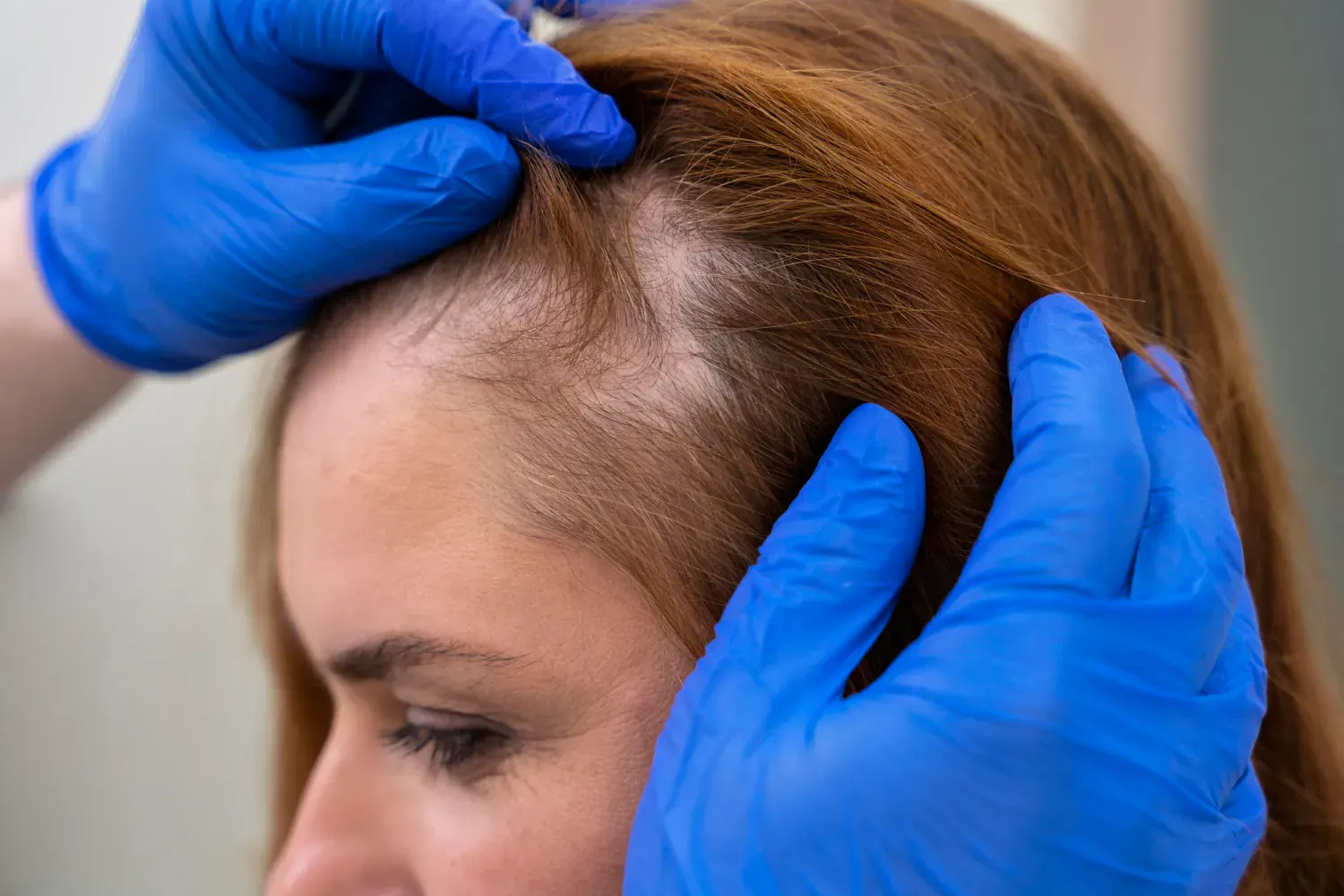 Close-up view of exosomes therapy being applied to the scalp for hair loss treatment in London