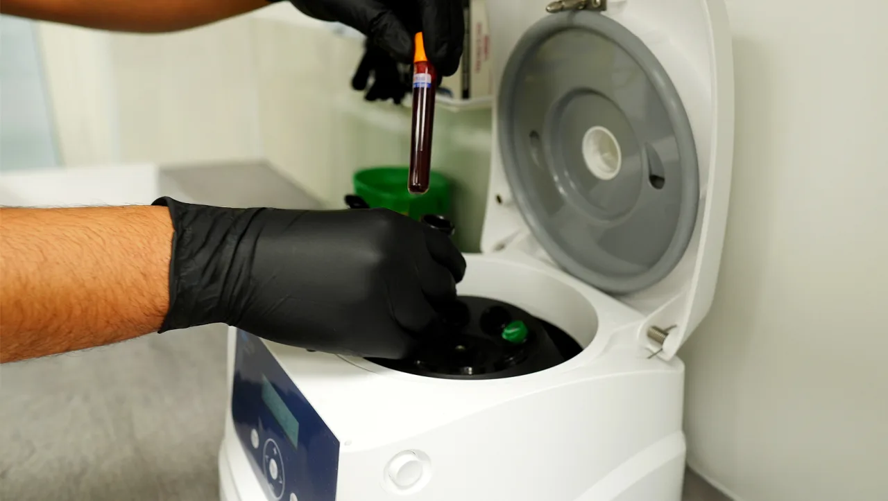 Application of PRP injections into the scalp for hair loss treatment in London