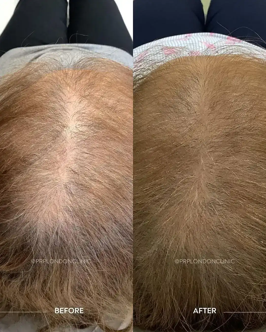 Diffuse Thinning (Female Pattern). Results after 3 sessions showing a significant narrowing of the central parting and increased frontal density.