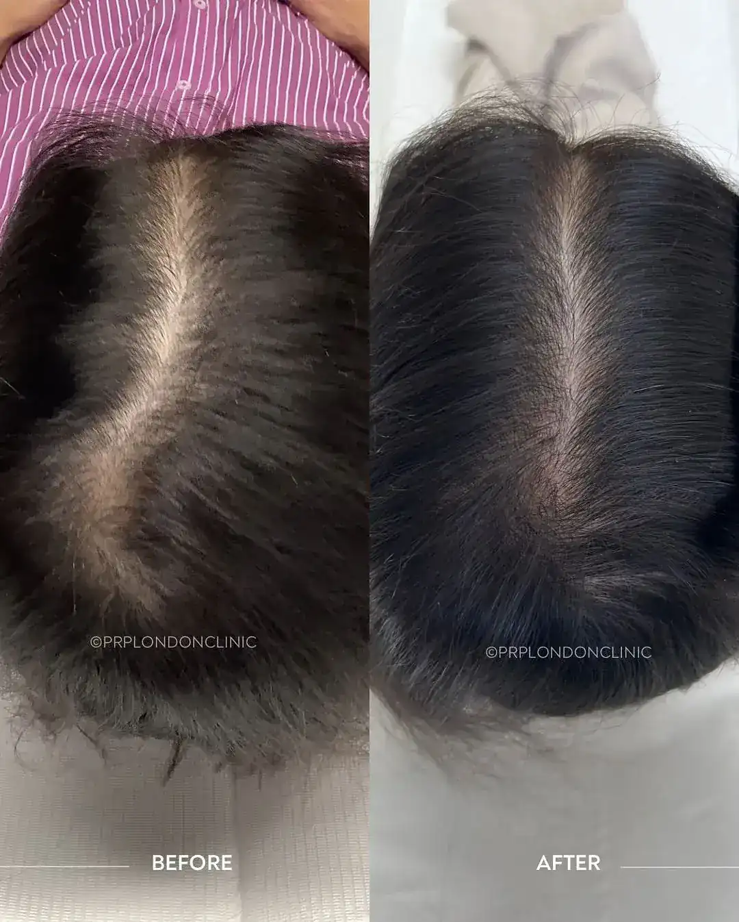 Diffuse Thinning (Female Pattern). Results after 3 sessions showing a significant narrowing of the central parting and increased frontal density.