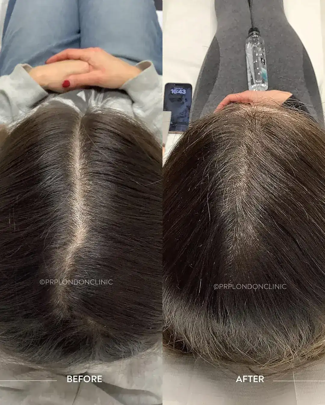 Diffuse Thinning (Female Pattern). Results after 3 sessions showing a significant narrowing of the central parting and increased frontal density.