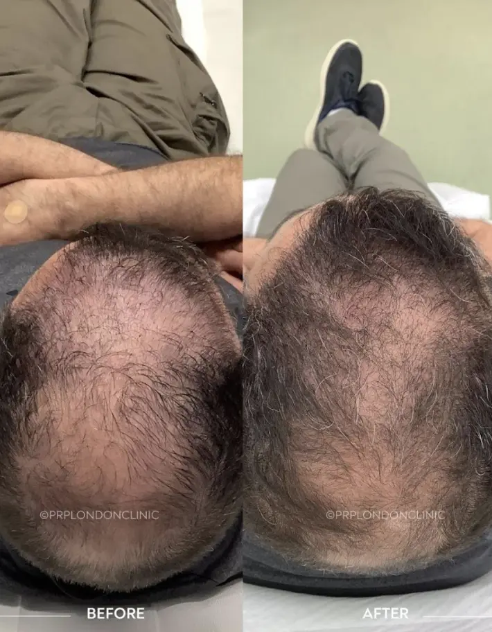 3 Month PRP for Hair Loss Before and After - Male Pattern Results PRP hair loss treatment before and after - advanced male pattern density recovery