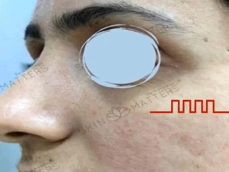 After Sylfirm X treatment - showing improved atrophic scar appearance