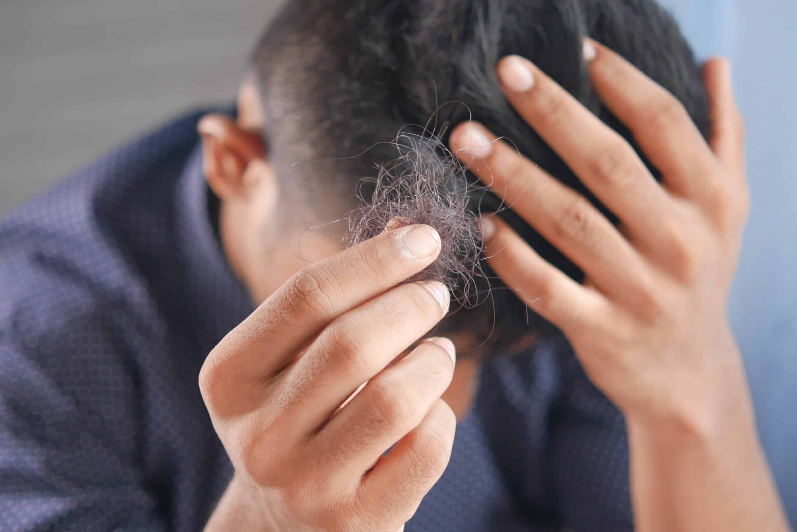 Does Minoxidil Shampoo Work?