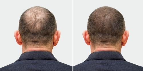 Top 10 Clinics for PRP Hair Treatment in London 2023